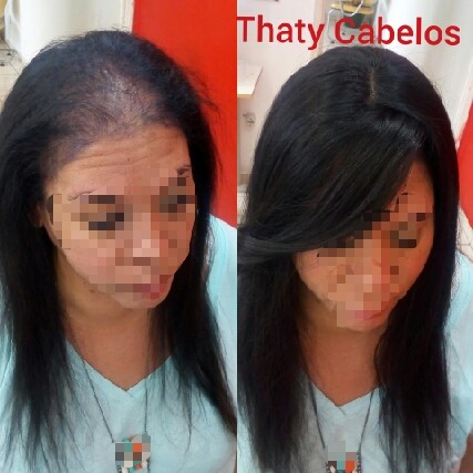 calvicie feminina